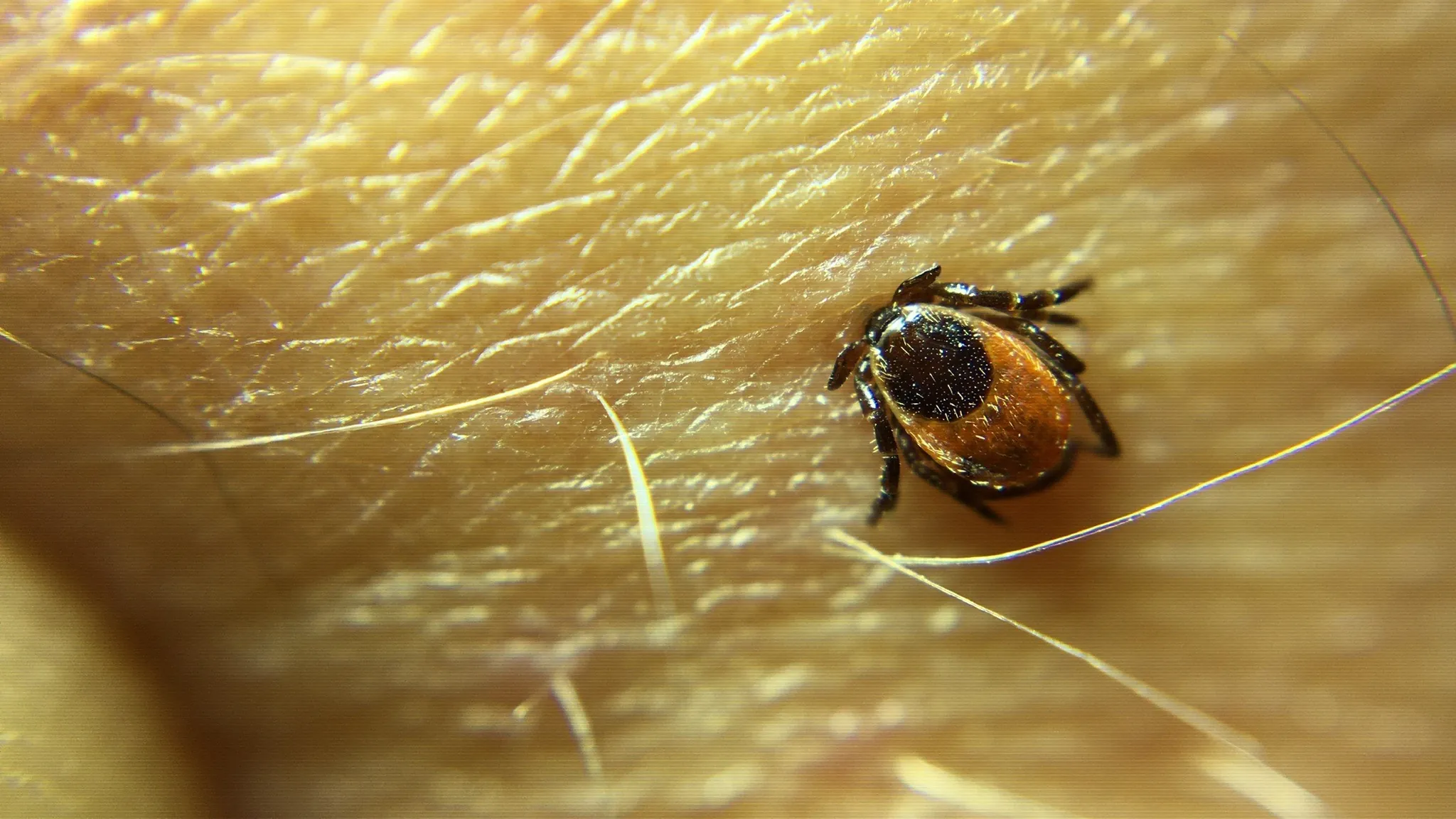 Close-up of a tick attached to human skin