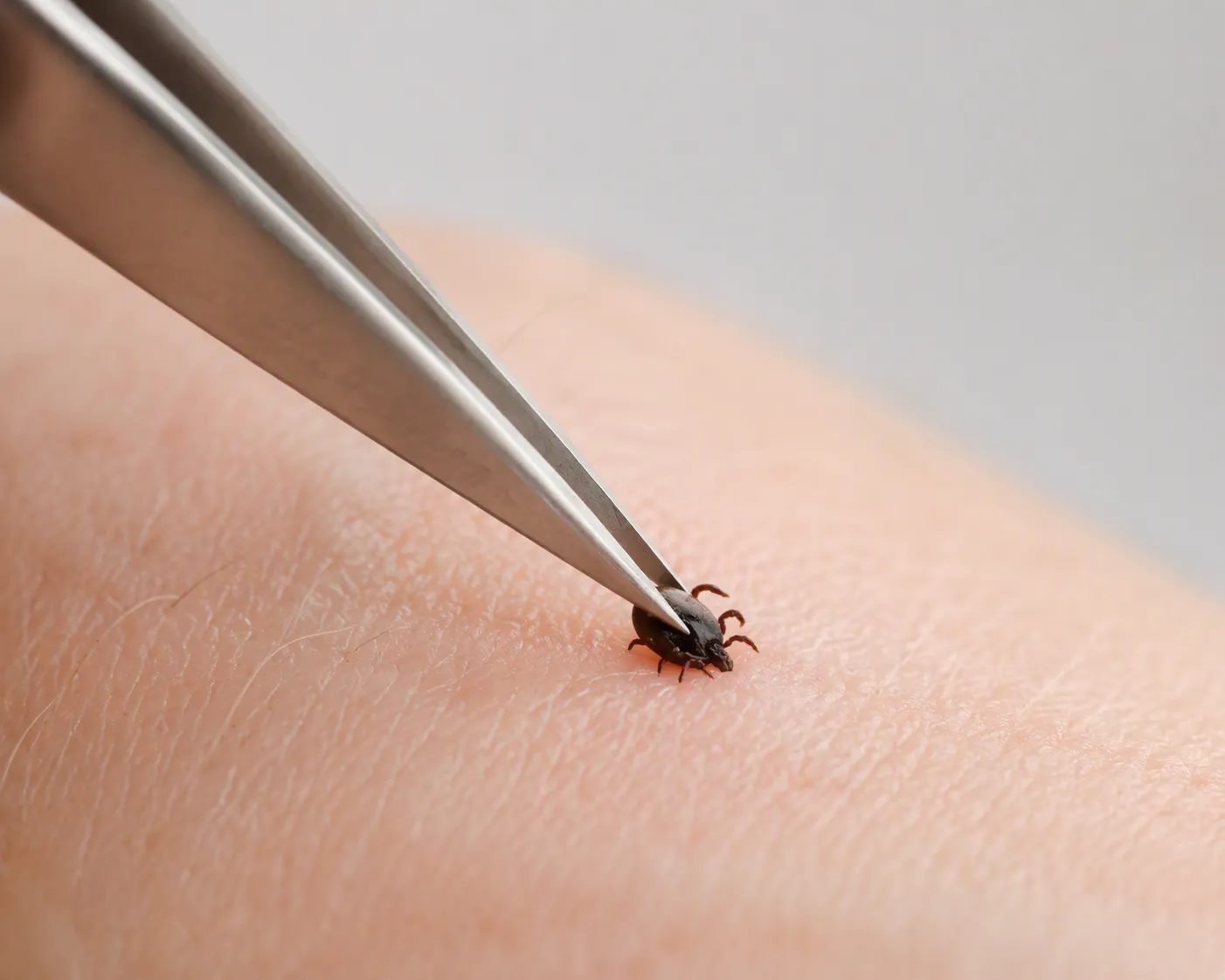 Fine-tipped tweezers gripping a small tick on skin