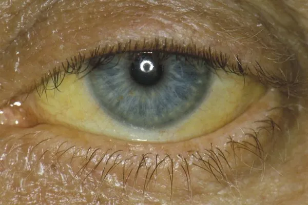 Close-up of an adult eye showing yellowing of the white of the eye from jaundice