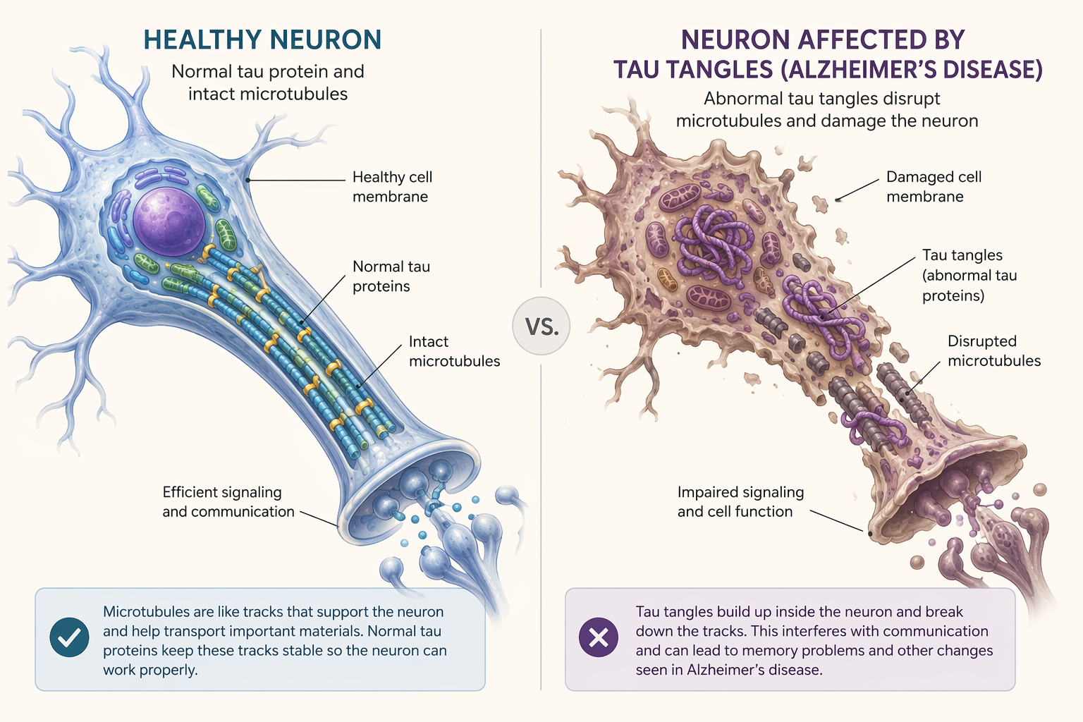 Healthy neuron with intact microtubules beside a degenerating neuron with tau tangles