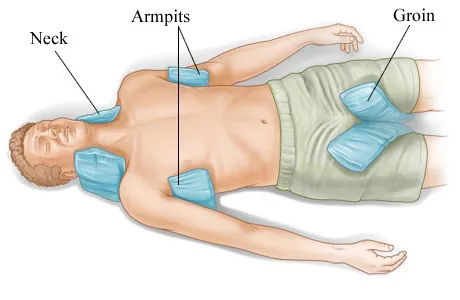Medical illustration showing ice bags placed on the neck, under the armpits, and at the groin for heat stroke cooling